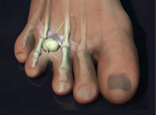 Foot Health: Neuromas