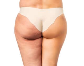 Qwo For Cellulite Reduction