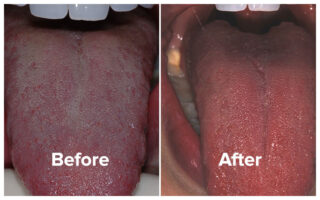 Tongue Rejuvenation Permanently Cures Chronic Bad Breath
